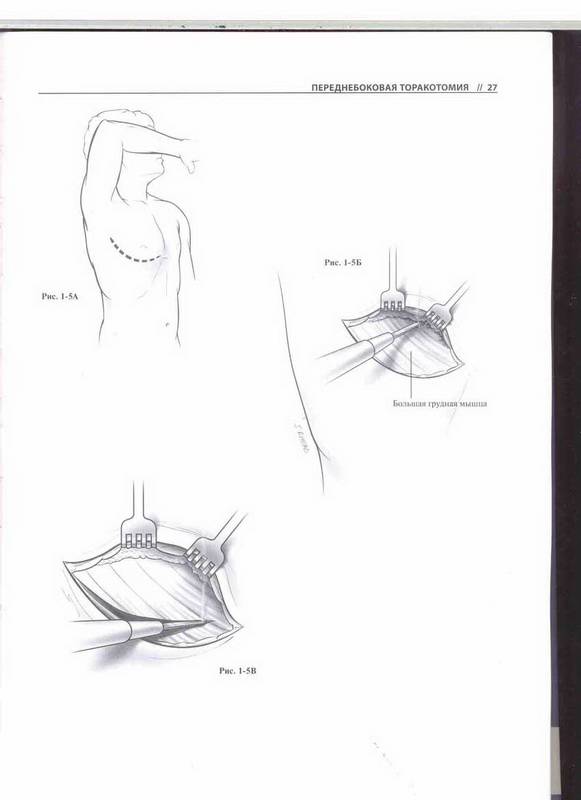 Иллюстрация 7 из 30 для Атлас торакальной хирургии - Марк Фергюсон | Лабиринт - книги. Источник: Ялина