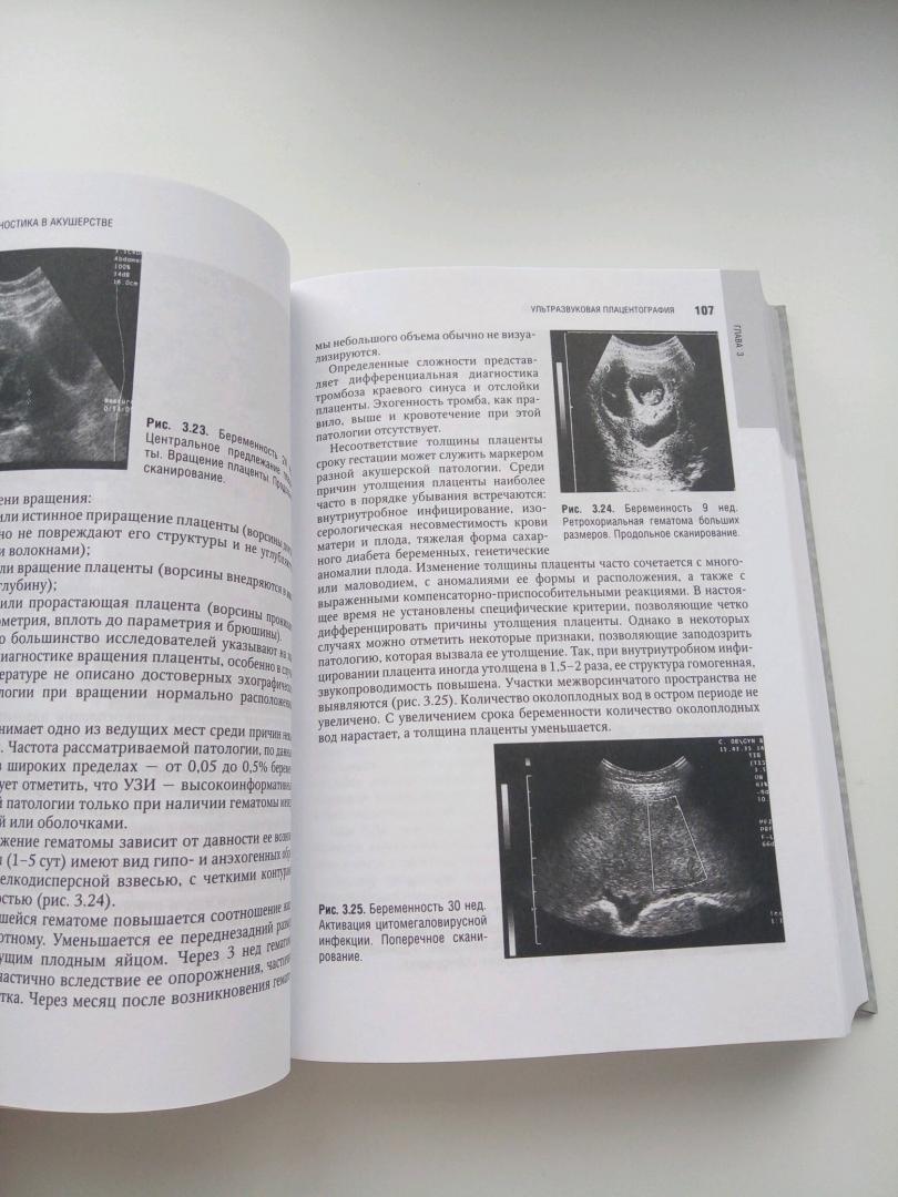 Иллюстрация 20 из 29 для Лучевая диагностика и терапия в акушерстве и гинекологии - Адамян, Гус, Демидов, Обельчак | Лабиринт - книги. Источник: Лабиринт