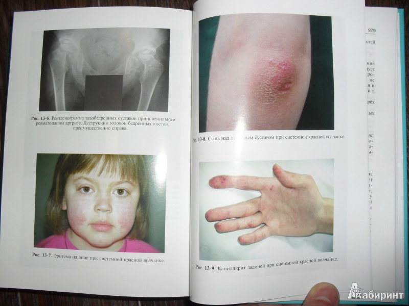 Иллюстрация 8 из 30 для Детские болезни. Учебник (+ CD) | Лабиринт - книги. Источник: ВраЧиталла