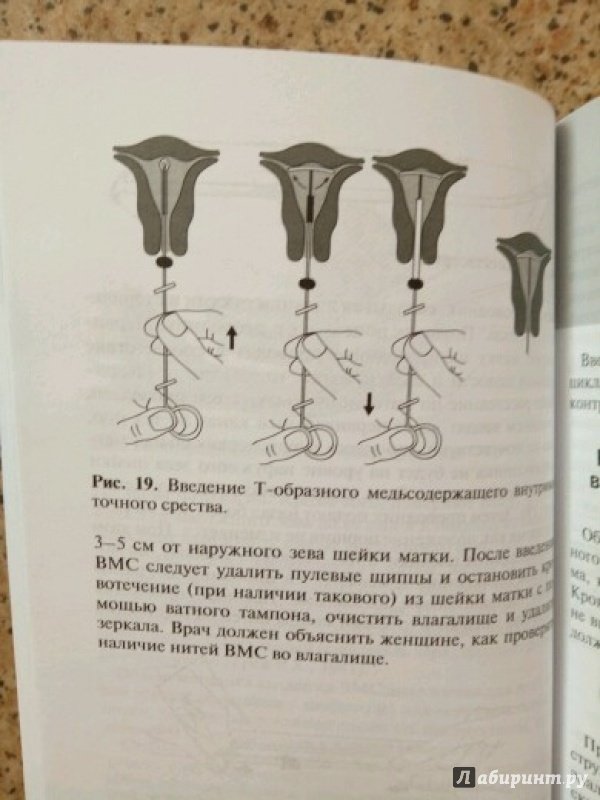 Иллюстрация 6 из 6 для Внутриматочная контрацепция - Прилепская, Межевитинова, Тагиева | Лабиринт - книги. Источник: Лабиринт