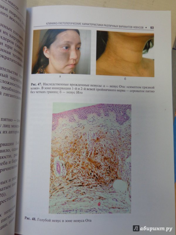 Иллюстрация 9 из 11 для Пигментные опухоли кожи - Лариса Червонная | Лабиринт - книги. Источник: Комарова  Екатерина