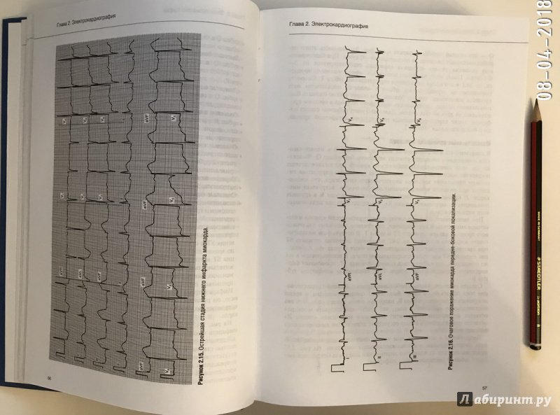 Иллюстрация 15 из 29 для Руководство по кардиологии. Том 2. Методы диагностики сердечно-сосудистых заболеваний | Лабиринт - книги. Источник: Ромыдтчъ