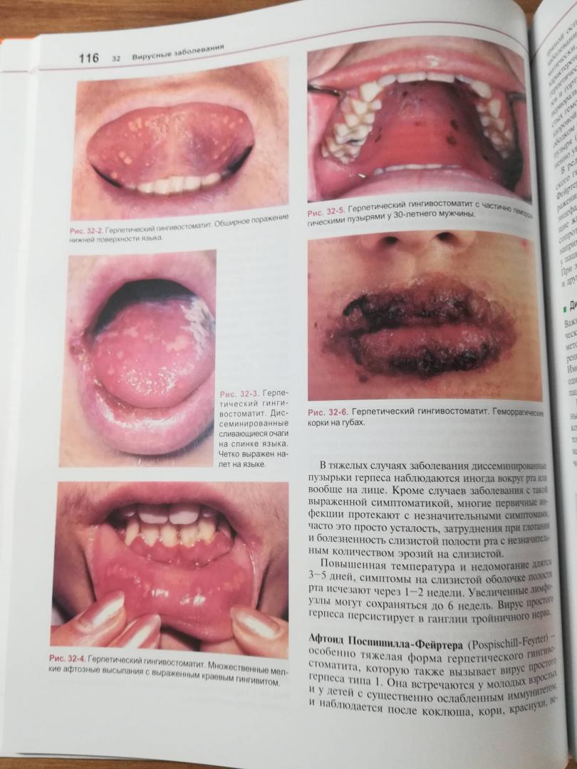 Иллюстрация 5 из 6 для Болезни слизистой оболочки полости рта и губ. Клиника, диагностика и лечение - Борк, Бургдорф, Хеде | Лабиринт - книги. Источник: Лабиринт