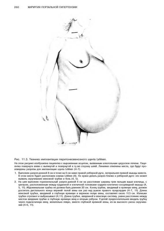 Иллюстрация 21 из 44 для Атлас абдоминальной хирургии. Том 1. Хирургия печени, желчных путей, поджелудочной железы - Эмилио Итала | Лабиринт - книги. Источник: Ялина