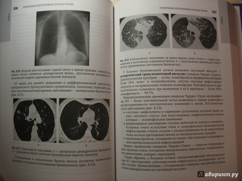 Иллюстрация 9 из 10 для Лучевая диагностика органов грудной клетки. Национальное руководство - Троян, Шехтер, Алексеева | Лабиринт - книги. Источник: Крелена