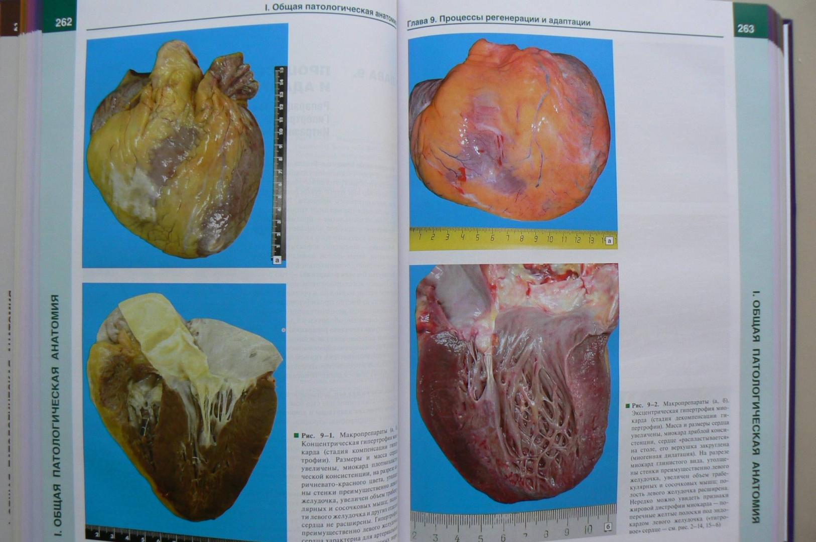 Иллюстрация 32 из 34 для Патологическая анатомия. Атлас. Учебное пособие - Зайратьянц, Бойкова, Зотова | Лабиринт - книги. Источник: Лидия
